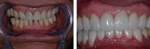 Cosmetic Dentistry Missouri City, TX - Porcelain Veneers, Alonso Family Dental