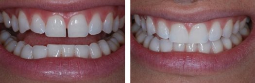 Restorative Dentistry Missouri City, TX - Composite Fillings, Alonso Family Dental