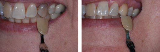 Teeth Whitening Treatments - Internal Bleaching of a Single Canine Tooth