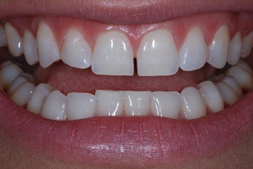 Composite-Fillings-Before